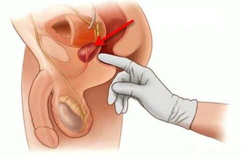 Prostatamassage bei Prostatitis