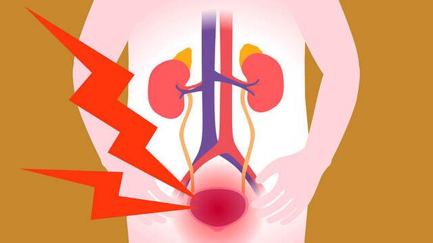 Schmerzen im Blasenbereich bei akuter Prostatitis